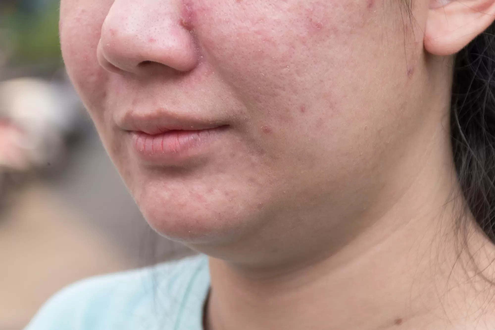 Acne and skin care concept. Young asian woman with pimple