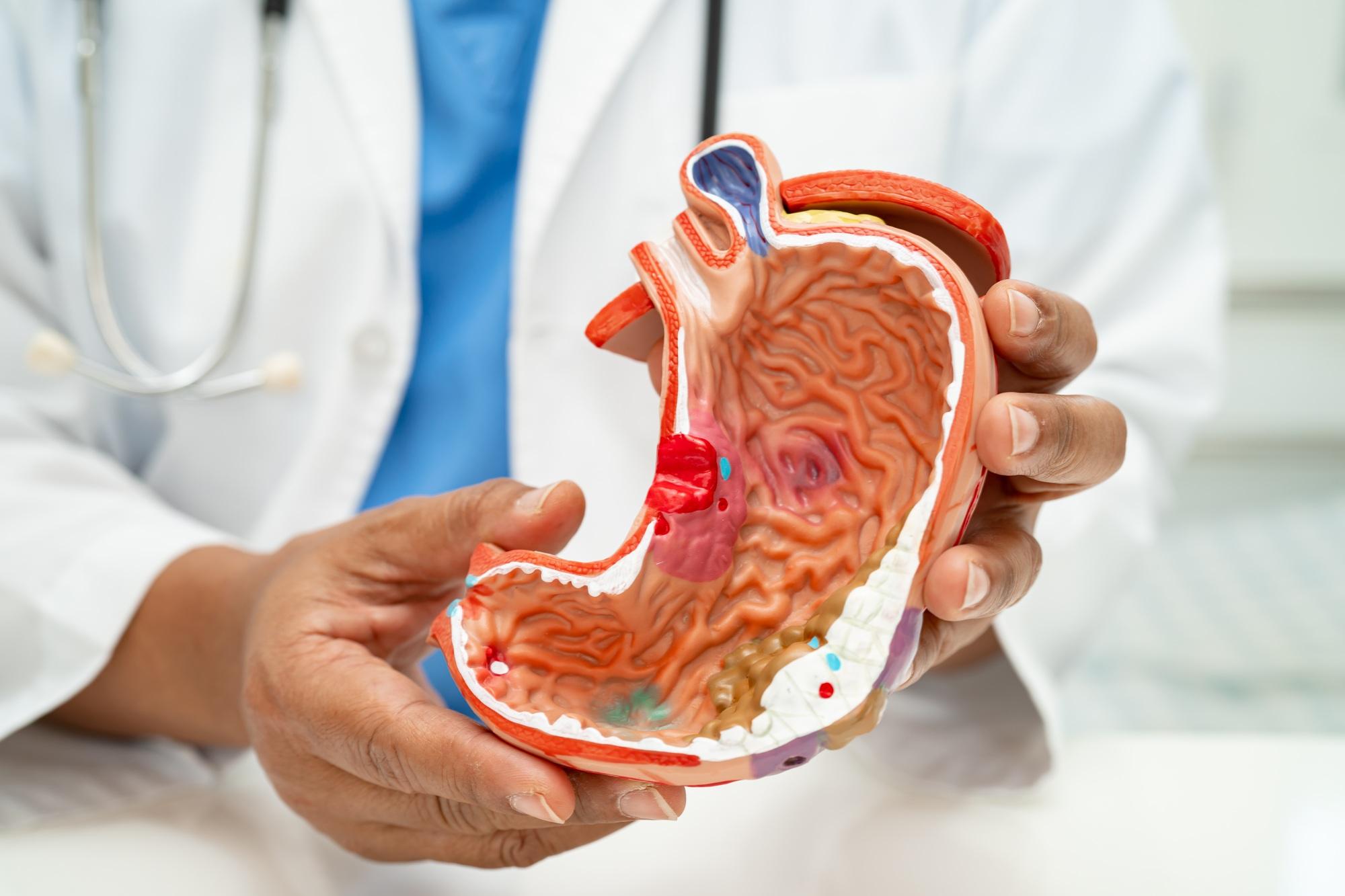 Stomach disease, doctor with anatomy model for study diagnosis and treatment in hospital.