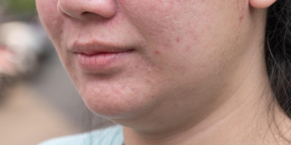 Acne and skin care concept. Young asian woman with pimple