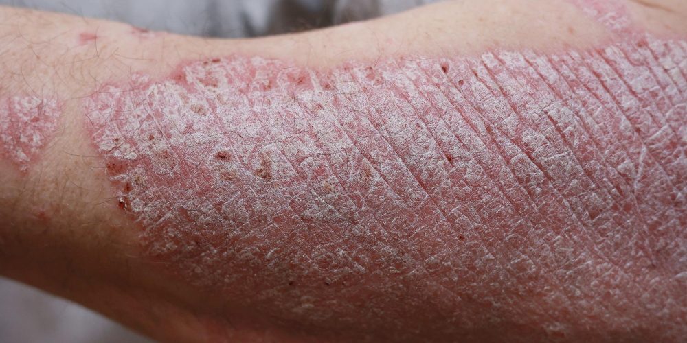 Close up, macro of psoriasis skin, autoimmune disease that affects the skin cause skin inflammation