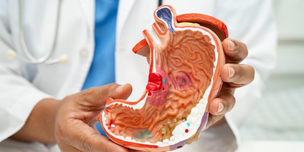 Stomach disease, doctor with anatomy model for study diagnosis and treatment in hospital.